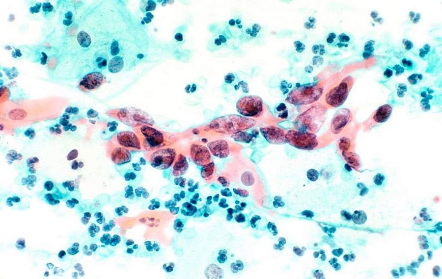 New test detects cervical cancer with 100 percent. effectiveness
